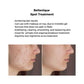 Bellenqiue Skincare Set for Acne, Pimple and Sensitive Skin - BEAUT.
